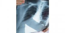 Akciğer kanseri hakkında doğru zannettiğimiz yanlışlar…