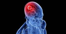 Beyin tümörüne karşı devrim yaratan yöntemler…